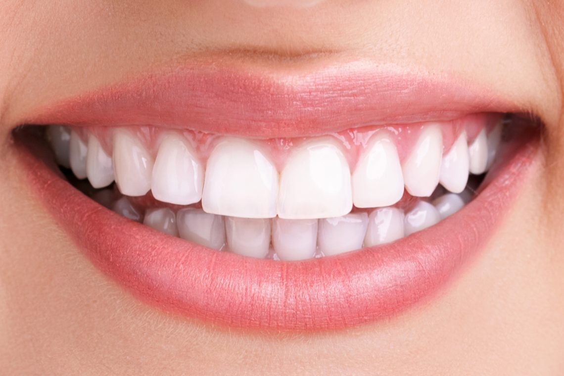 After Teeth-whitening