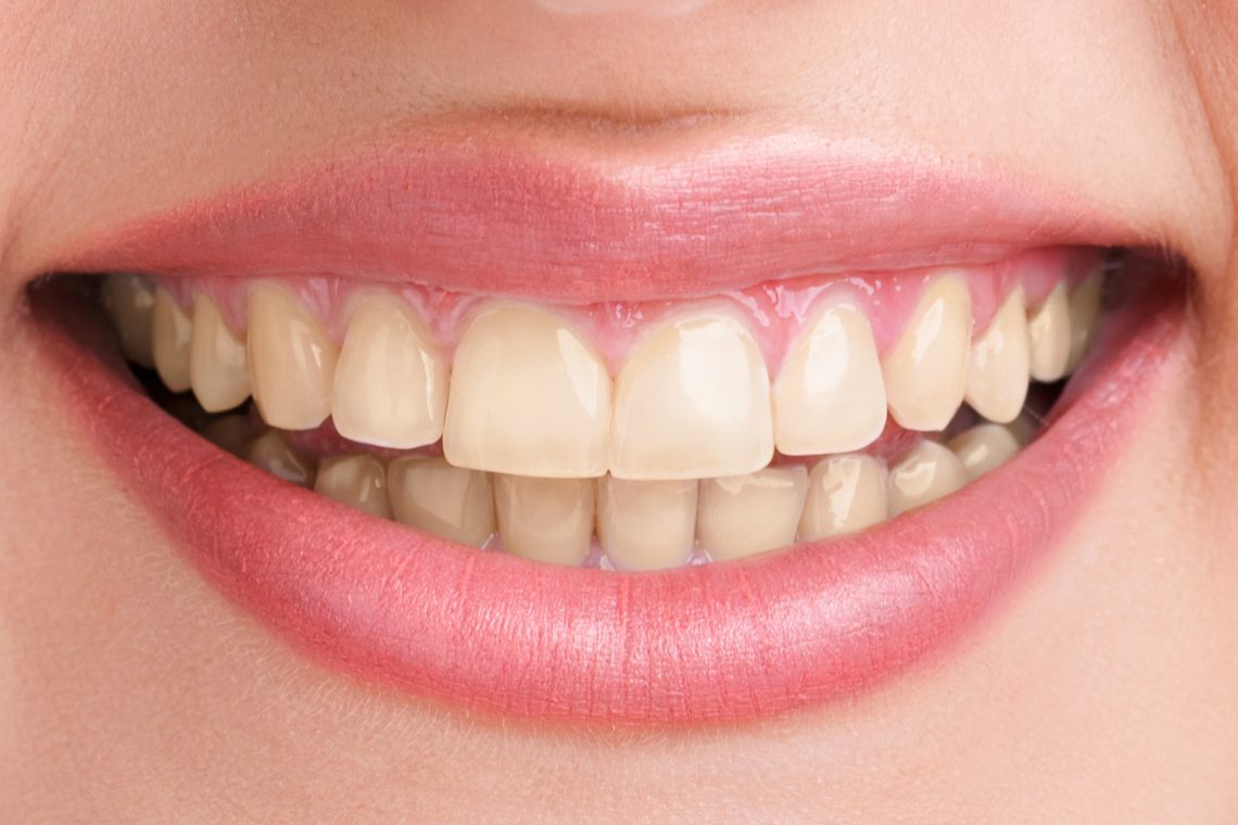 Before Teeth-whitening